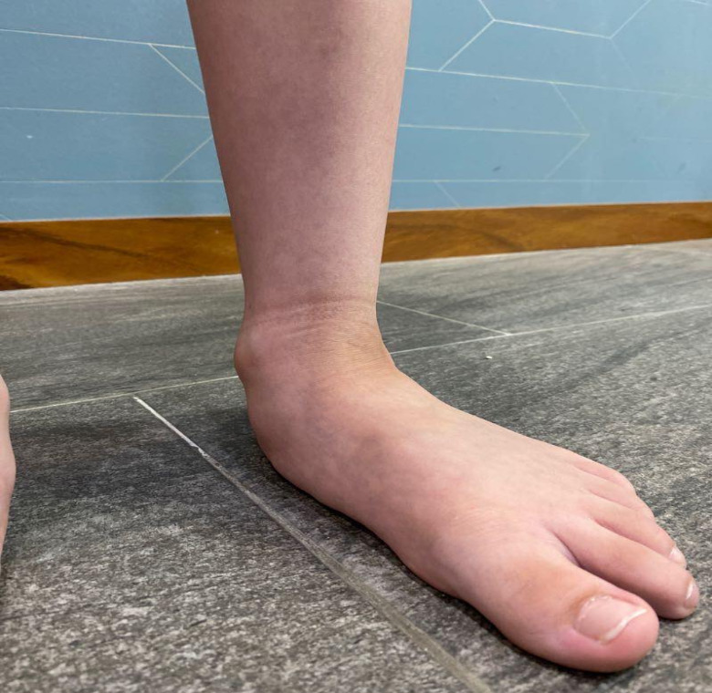 pie plano limitacion actividades