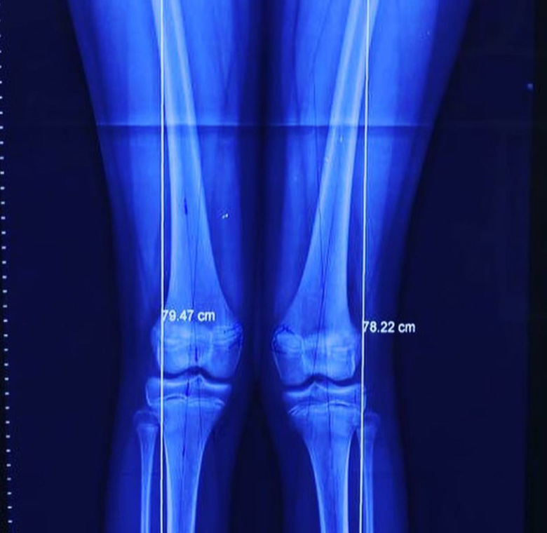 deformidad rodillas en valgo