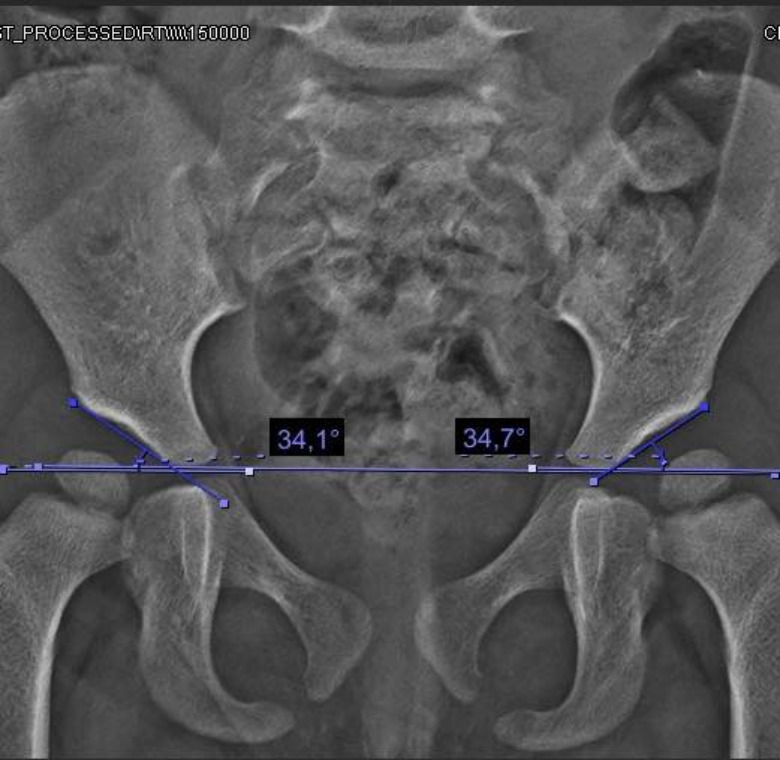 ectrodactilia deformidad en  pie