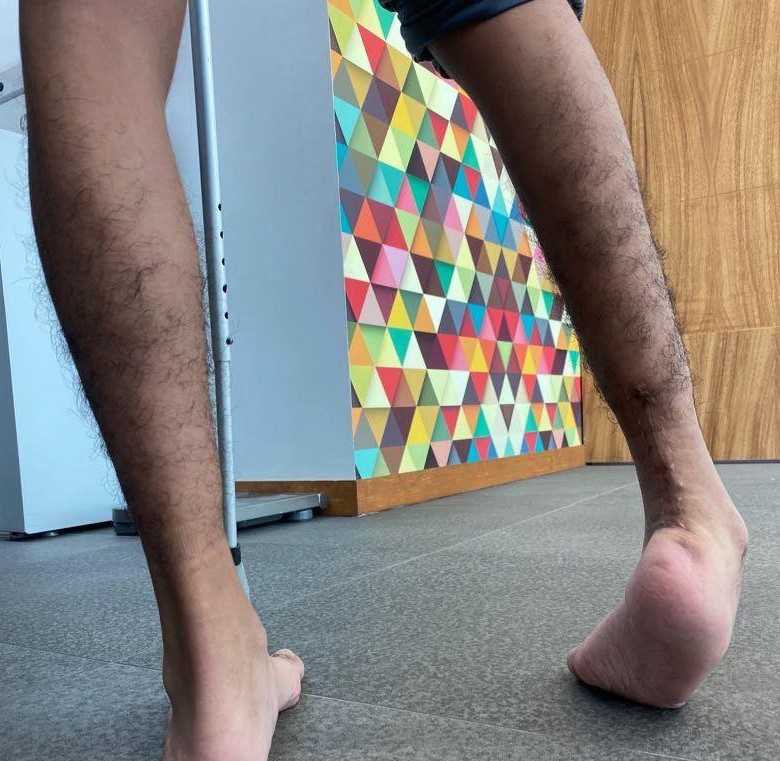 ectrodactilia deformidad en  pie