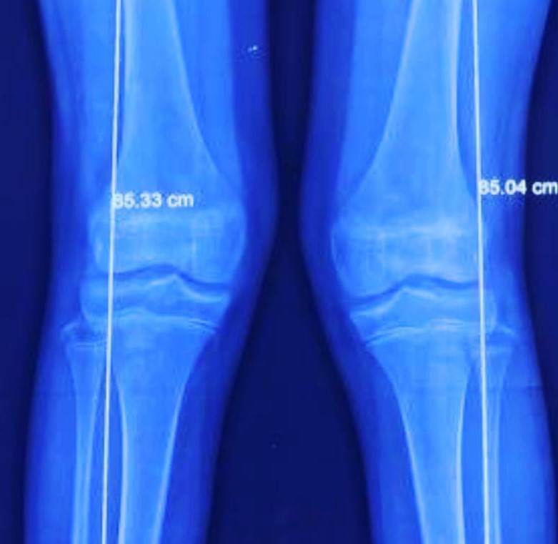 ectrodactilia deformidad en  pie