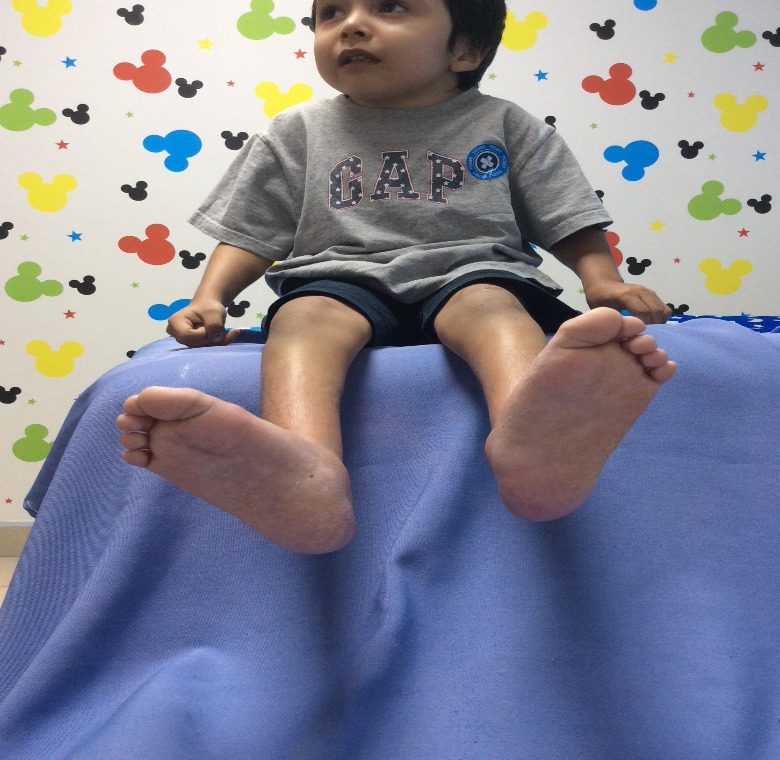 ectrodactilia deformidad en  pie