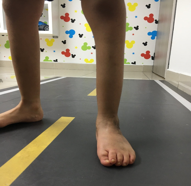 ectrodactilia deformidad en  pie