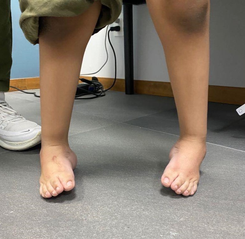 pie equinovaro bilateral