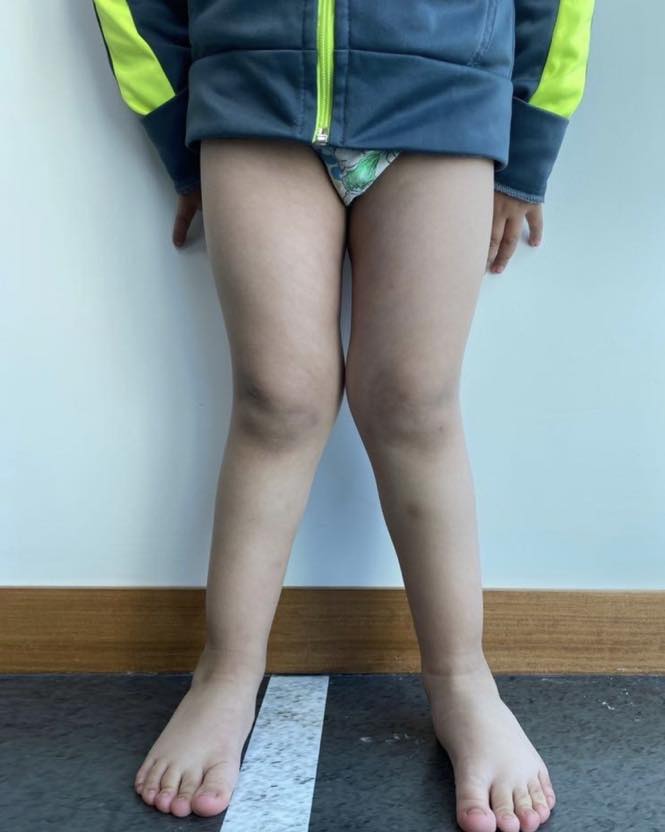 pie plano limitacion 4