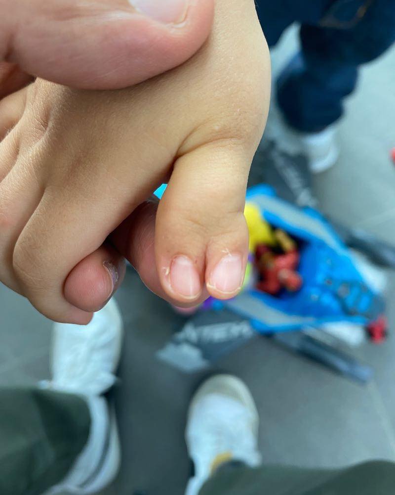 recostruccion de pulgar 1