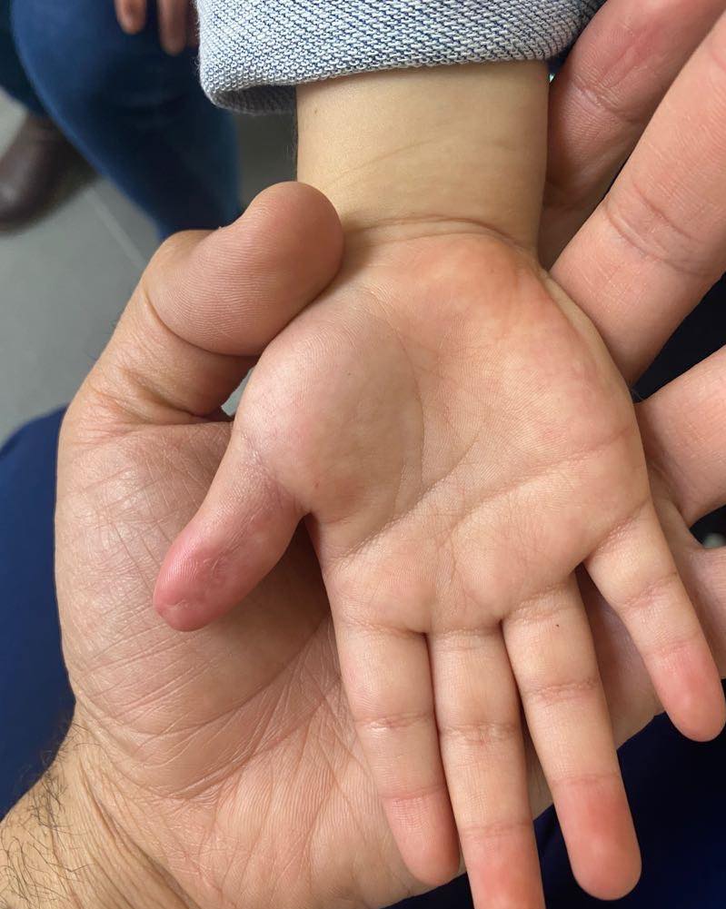 recostruccion de pulgar 3