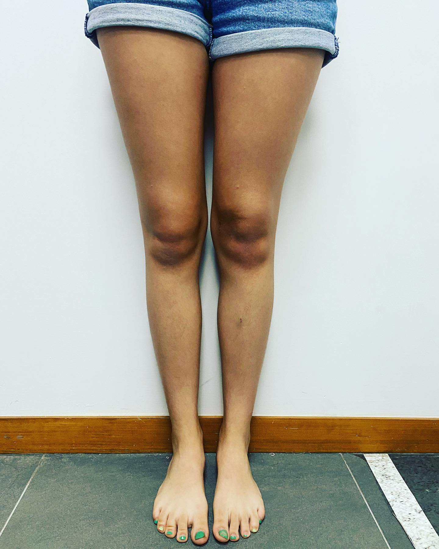 deformidad rodillas en valgo 4