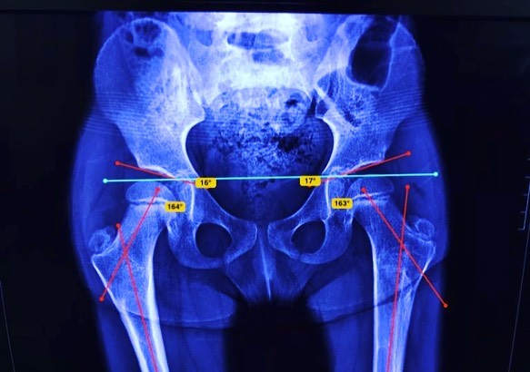 displasia de cadera 5