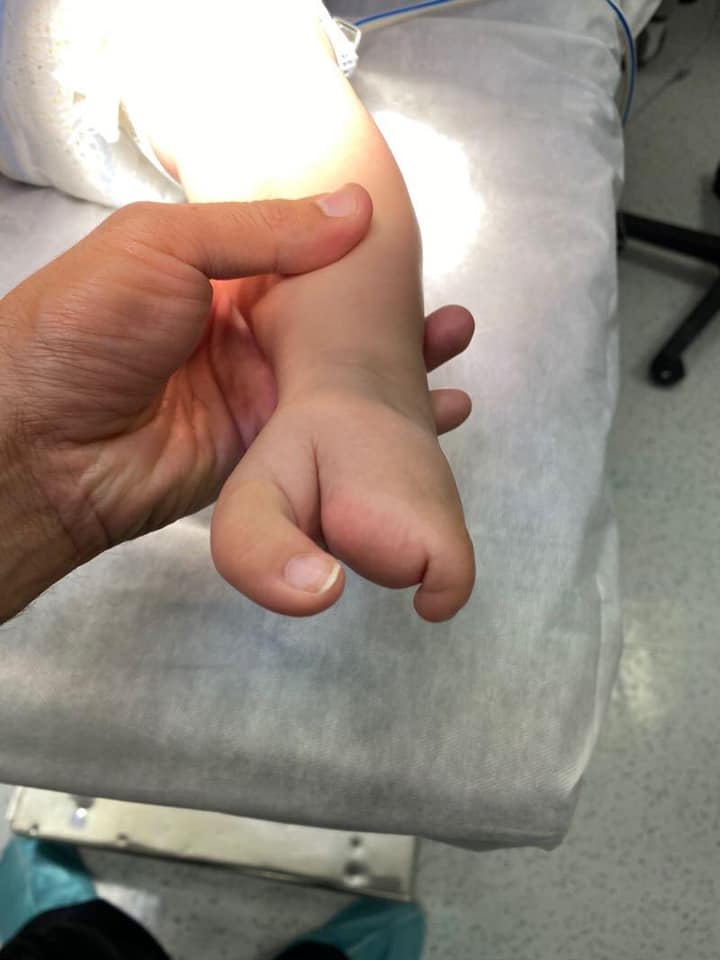 ectrodactilia deformidad en pie 6