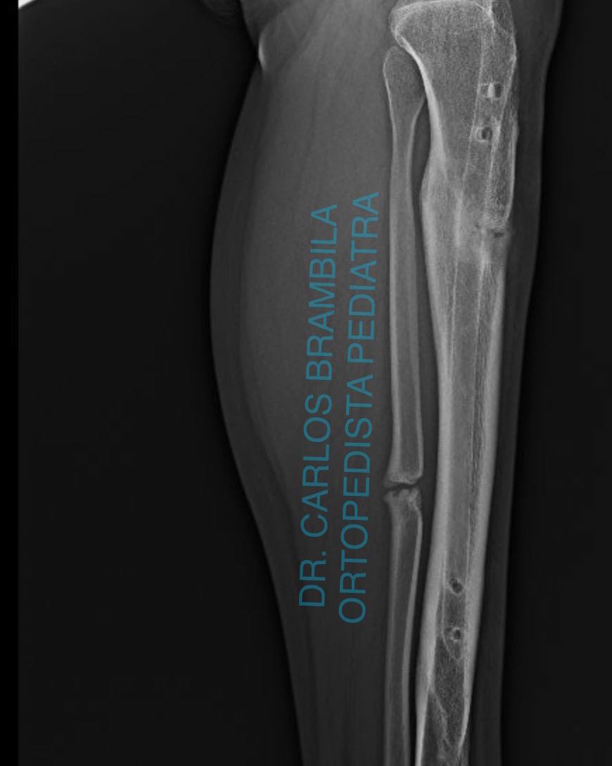 fractura de tibia 7