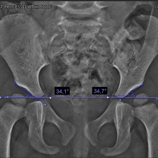 displasia de cadera 2