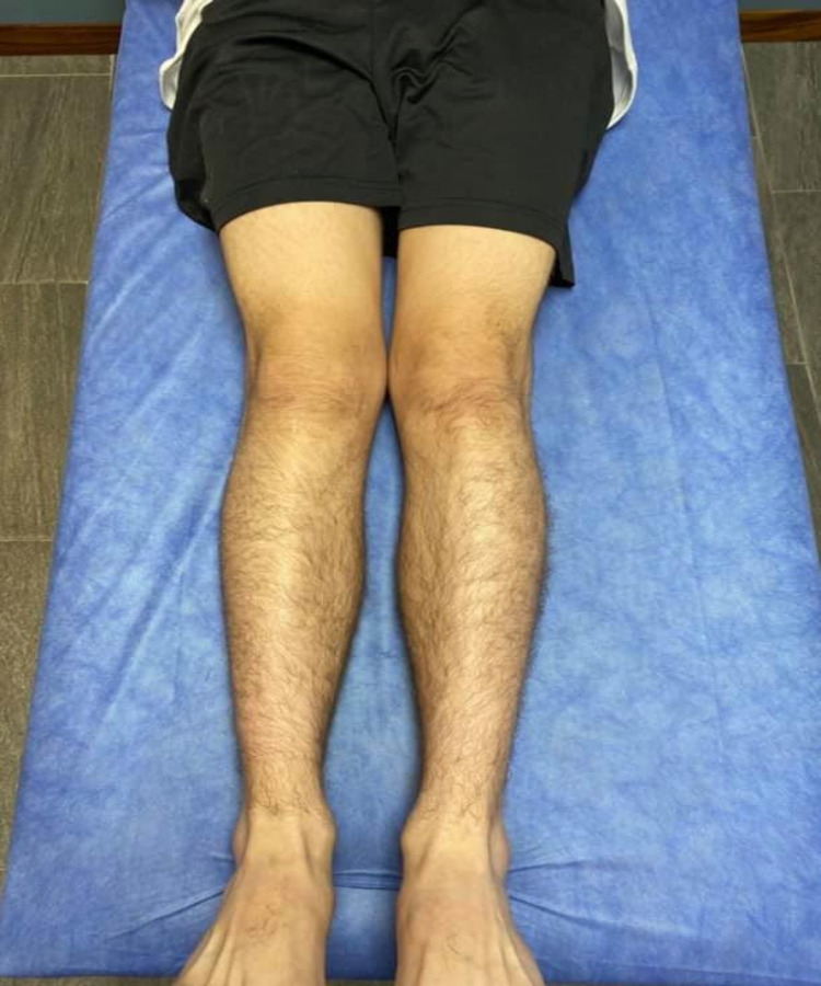 Rodillas en valgo con rótula alta 3