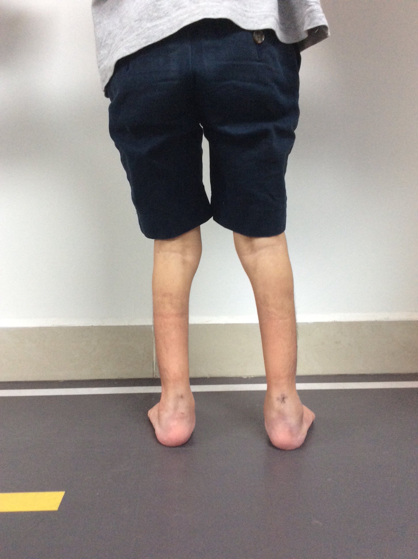 Enfermedad neurológica deformidad en pies 5