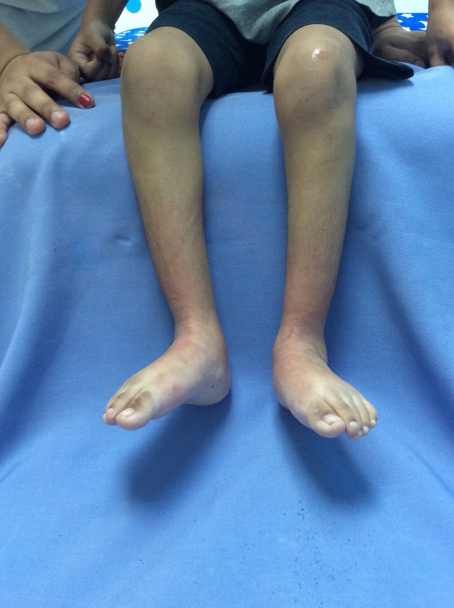 Enfermedad neurológica deformidad en pies 5