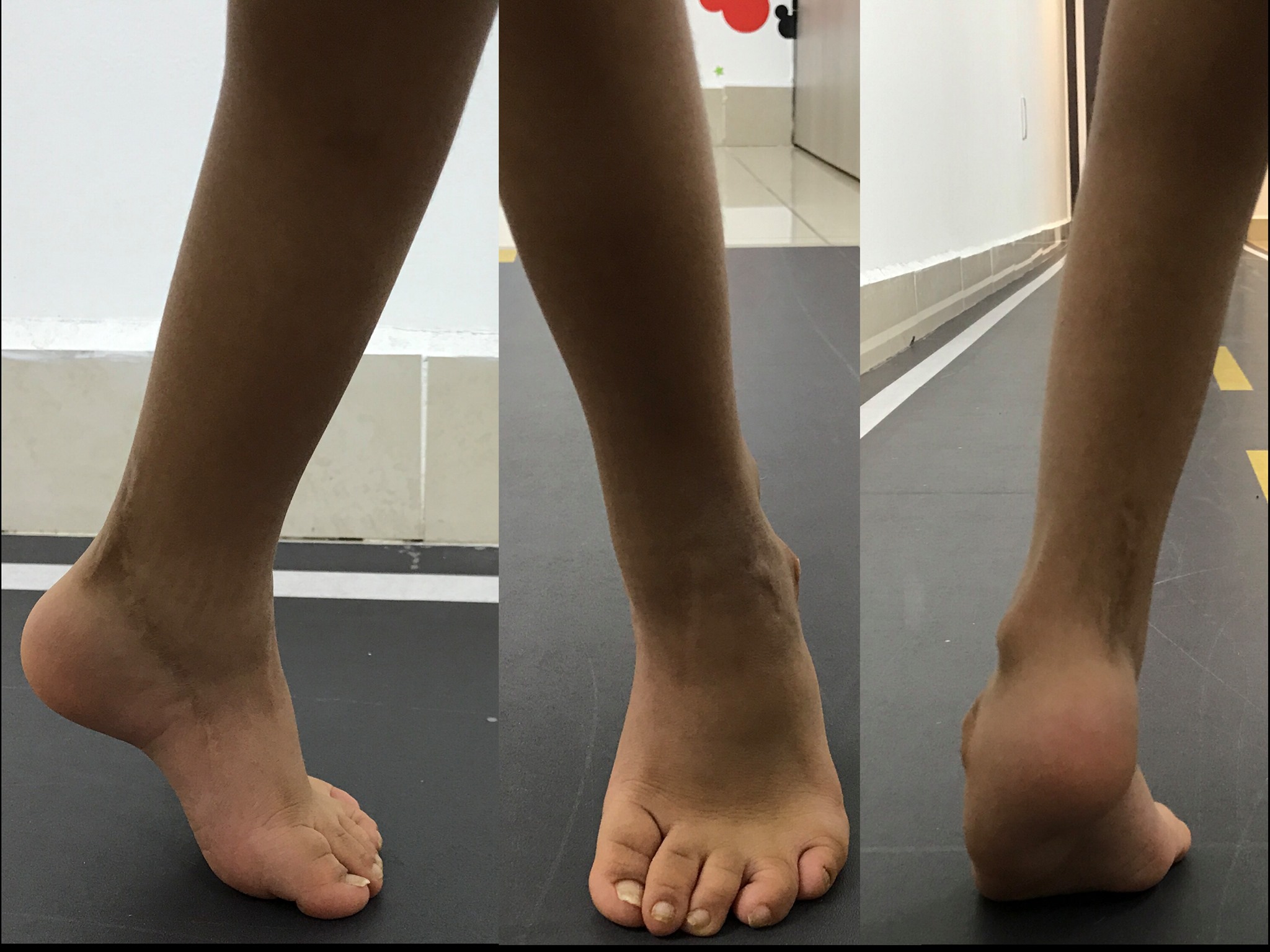 Enfermedad neurológica deformidad en pies 2