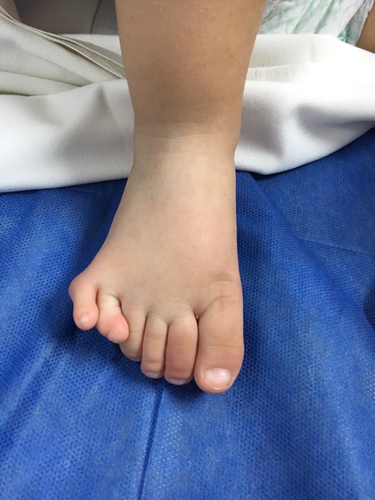 polidactilia en ambos pies 2