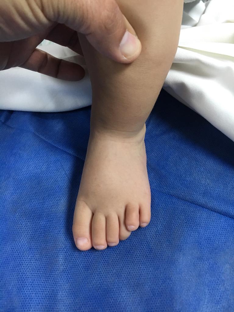 polidactilia en ambos pies 3