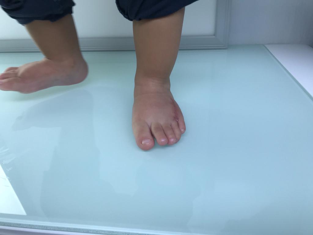 polidactilia en ambos pies 5