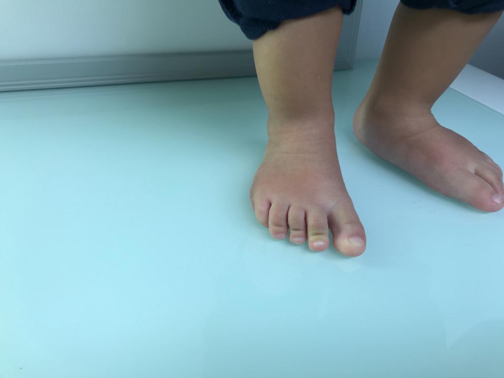 polidactilia en ambos pies 6