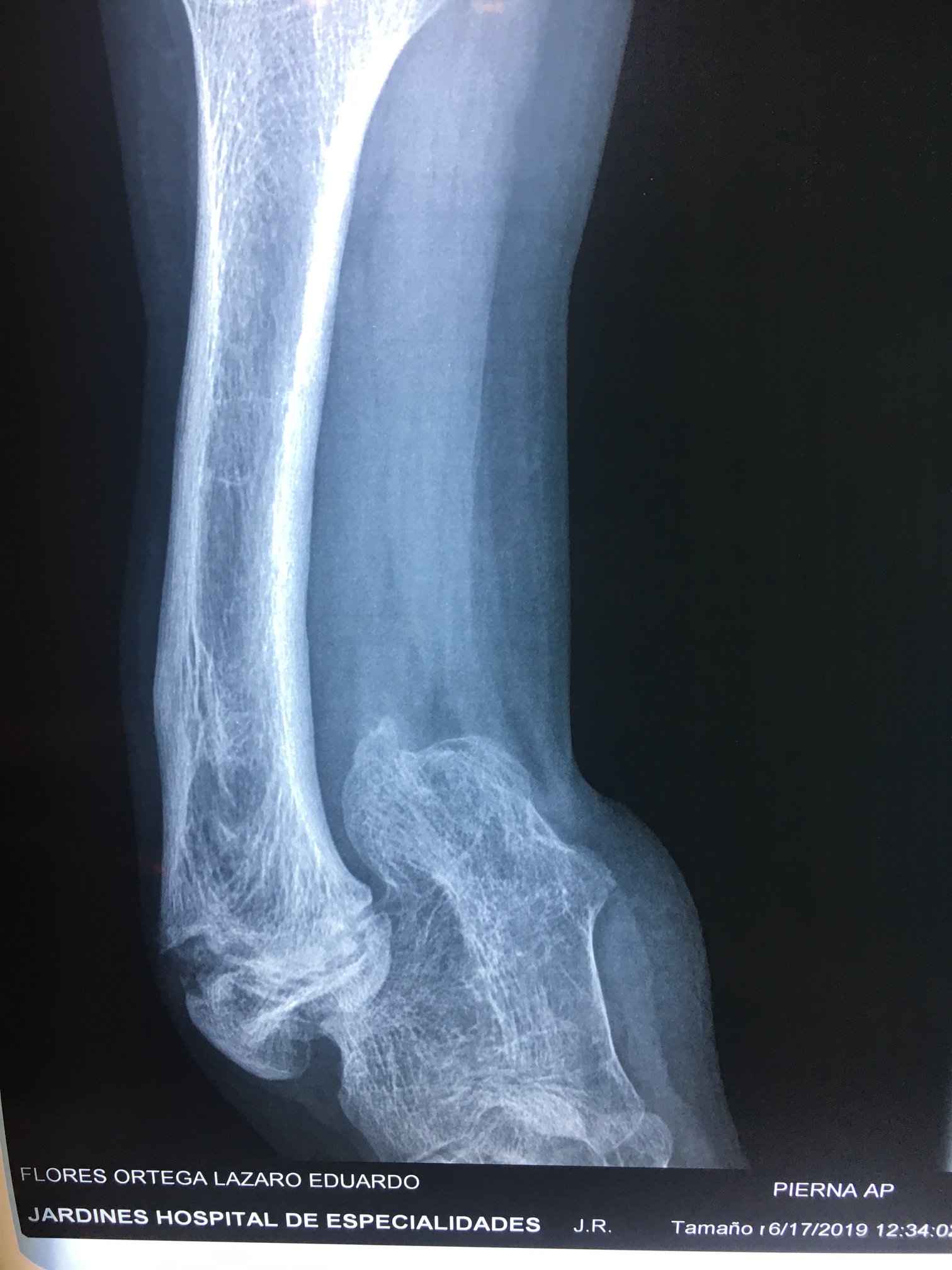 Ausencia congenita del peroné 4