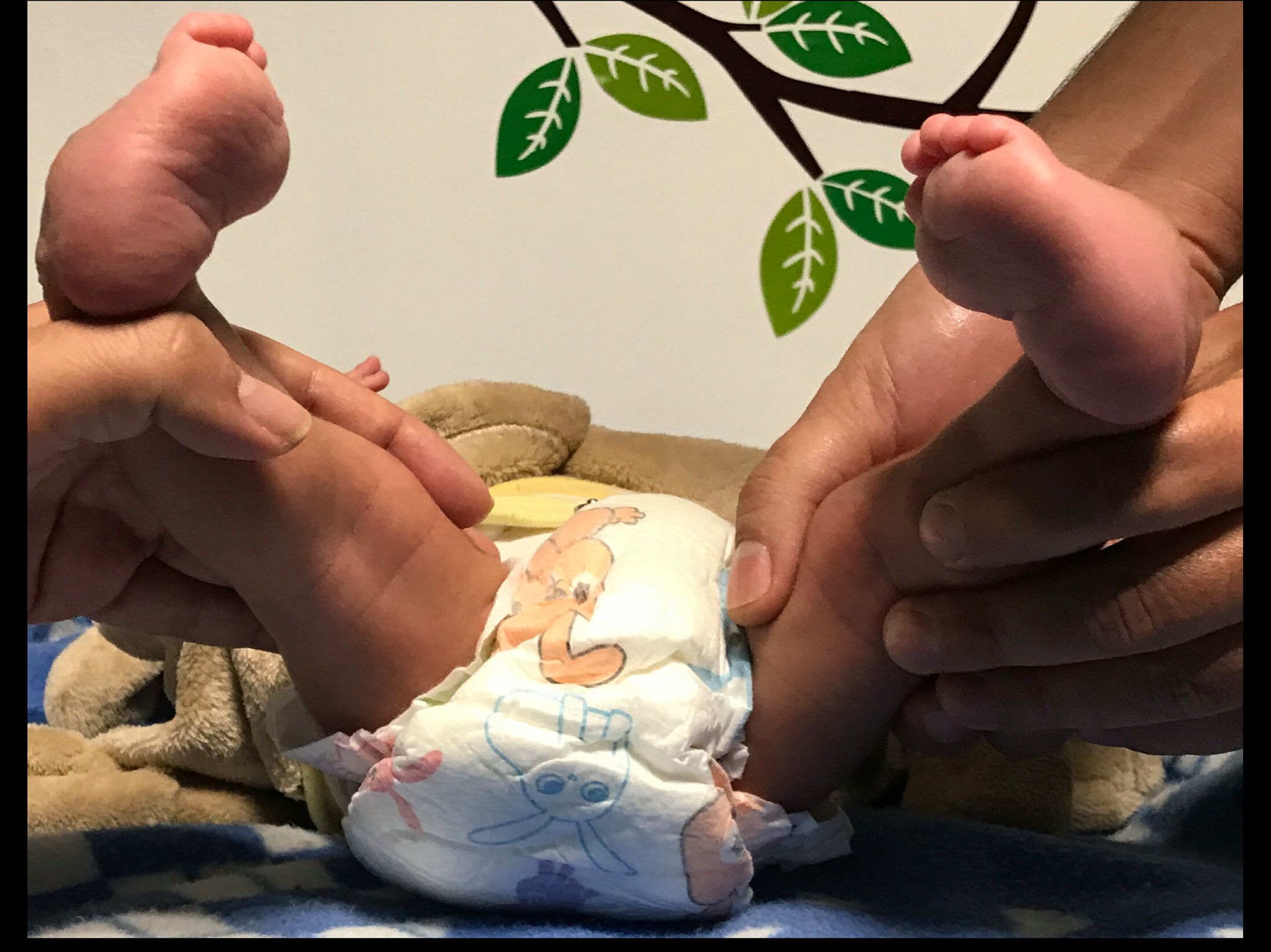 Inicio tratamiento de pie equino varo 4