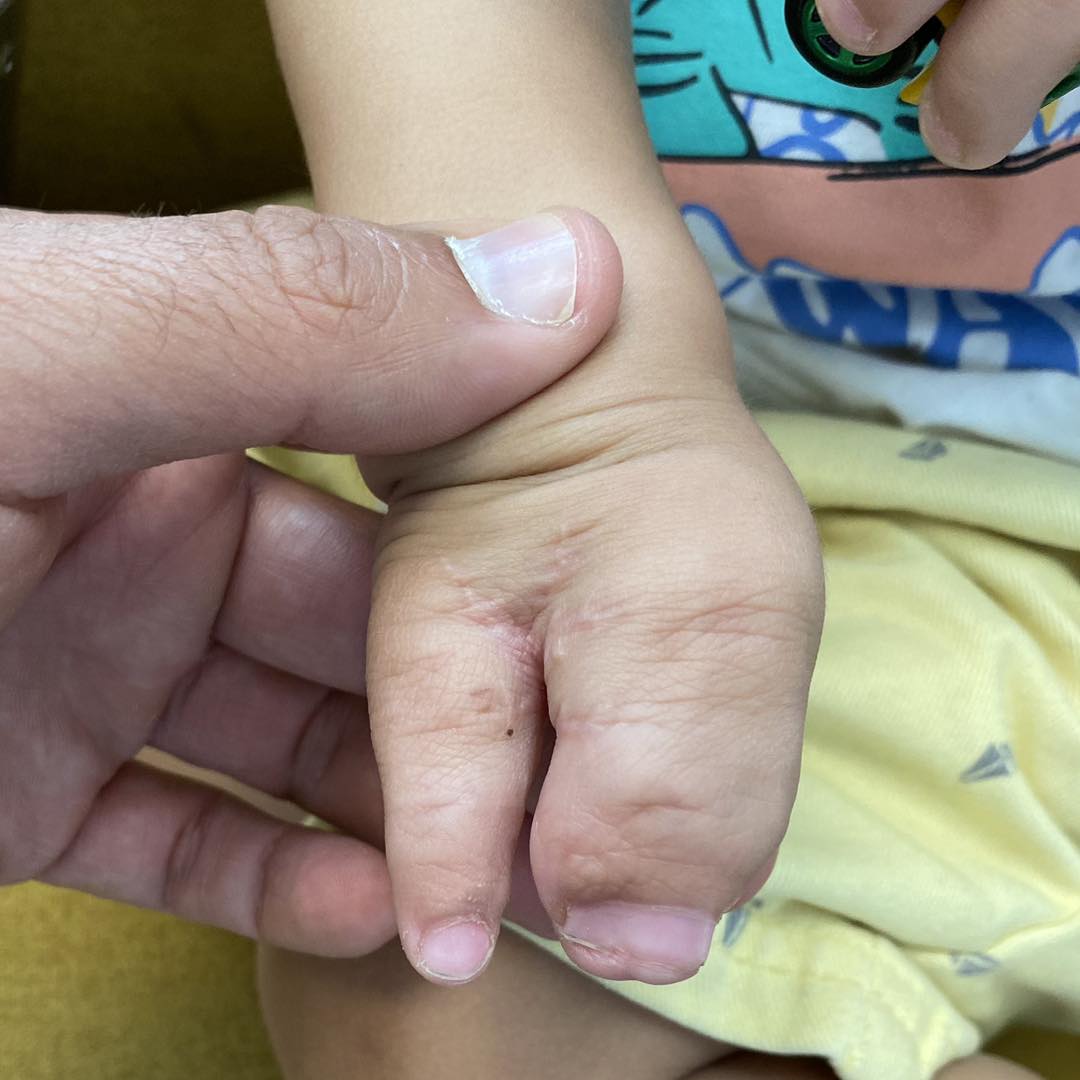 reconstrucción mano 5