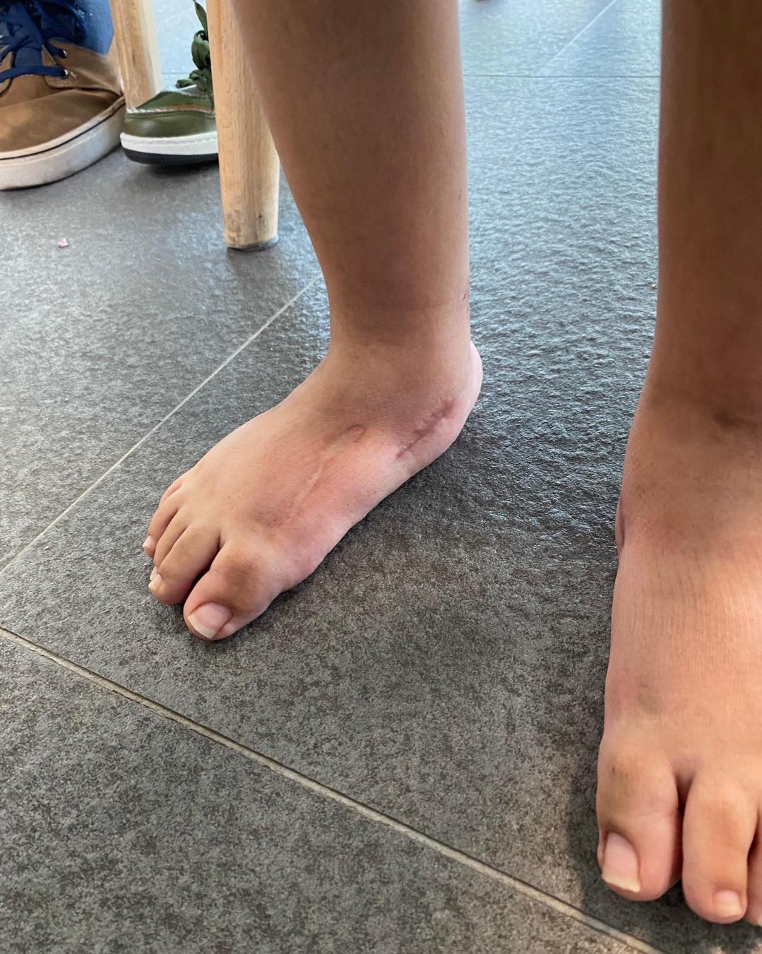 pie equinovaro bilateral 5