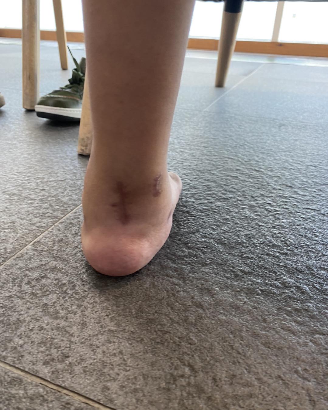 pie equinovaro bilateral 6