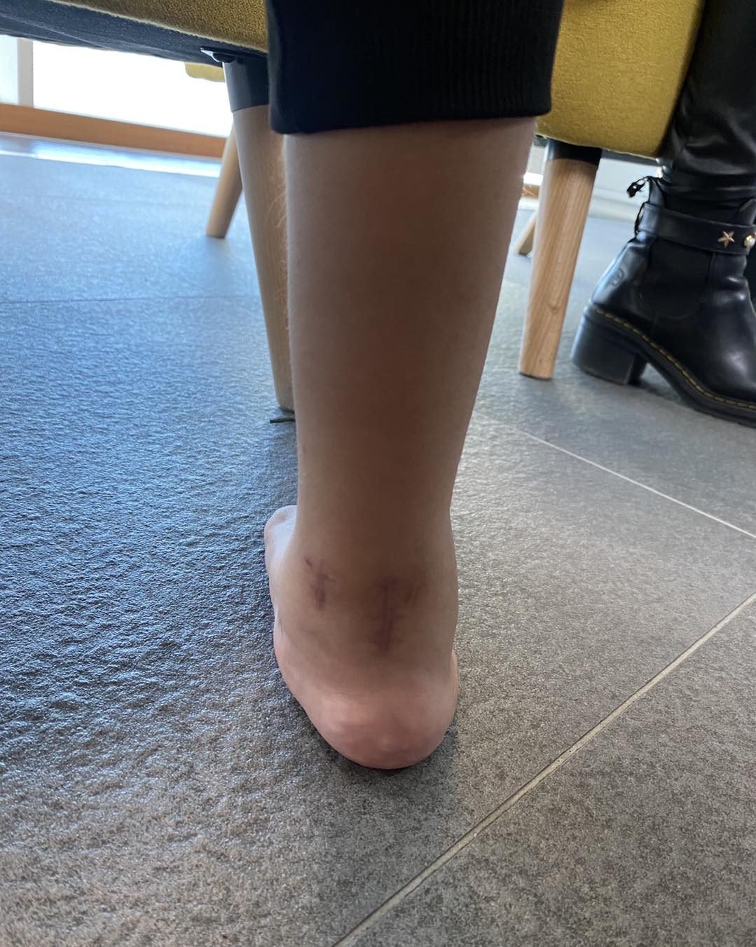 pie equinovaro bilateral 6